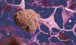 Beyindeki lityum düşüklüğü Alzheimer ile ilişkili bulundu