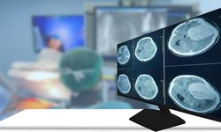 Beyin Kanseri Glioblastoma’da Umut Veren Laboratuvar Bulguları