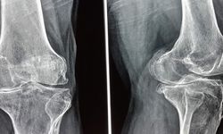 Diz Kireçlenmesinde Ameliyatsız Tedavi Seçenekleri
