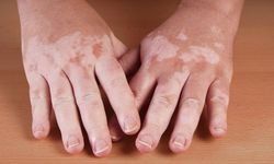 Vitiligo nedir? En güncel tedavi yöntemlerinde yeni dönem