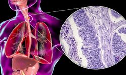 T-Hücre Kanserine Hedefe Yönelik Yeni Tedavi