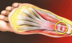 Ayaklarda yanma hissi: nedenleri ve güncel tedaviler