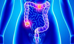 50 Yaş Altında Mide ve Bağırsak Kanseri Yükselişte mi?
