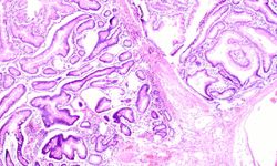 Peutz–Jeghers sendromu nedir, güncel tedaviler neler?