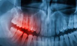 İmplant yerine doğal diş mümkün mü? İnsan deneyleri başladı