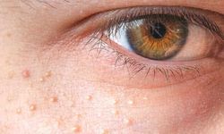 Yağ Bezesi Sanılıyor: Milia Nedir, Nasıl Geçer?