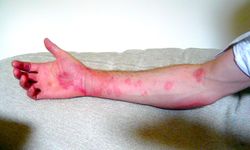 Ürtiker Hakkında Doğru Bilinen Yanlışlar: Uzman Görüşü