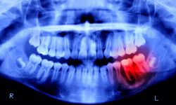 Japonya’dan devrim niteliğinde adım: İnsanlarda dişlerin yeniden çıkmasını sağlayan ilaç denemeleri başladı