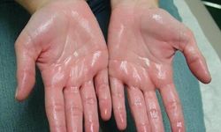 “Terlemek kaderim” demeyin: Aşırı terleme için tıbbi tedavi mümkün