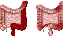 Dışkıda kan görmek ne anlama geliyor? Uzmanlar uyarıyor: küçük belirti, büyük mesaj olabilir