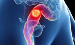 Rektum kanserinde ameliyat devri bitiyor mu? Yeni çalışma ne vadediyor?