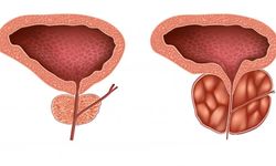 Prostatit Nedir? Belirtiler ve Tedavi Yaklaşımları