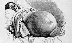 1809’da Tıbbın Korkusunu Yıkan Kadın: Jane Todd Crawford’un Olağanüstü Ameliyatı