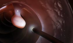 Kolonoskopi Öncesi Hazırlık Neden Önemli?