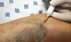 Köpükle Varis Tedavisi Nedir? Kimlere Uygun, Nasıl Etki Ediyor?