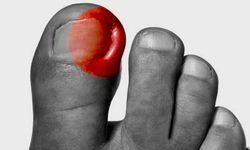 Tırnak Batması Sessizce İlerliyor: Yanlış Kesim En Büyük Neden