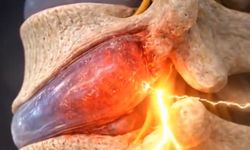 Disk Fıtığı Sinir Baskısıyla Ağrı, Uyuşma ve Güçsüzlüğe Neden Olabiliyor