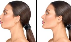 Jawline (çene hattı) Estetiği Nedir? Çene Hattı Hakkında Merak Edilenler