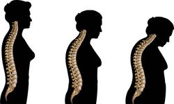 Kırık Olana Kadar Fark Edilmiyor: Osteoporoz Sessizce Nasıl İlerliyor?