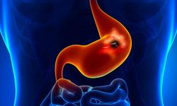 Peptik ülser nedir? En yeni teşhis ve tedavi yöntemleri