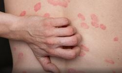 Ciltte Tek Bir Leke ile Başlıyor: “Herald Patch” Nedir?