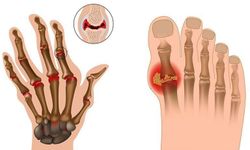 Romatoid Artritte Sessiz Başlangıç: Erken Tanı ve Güncel Tedaviler Hastalığın Seyrini Değiştiriyor