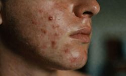 Sivilce (Akne Vulgaris) Nedir?