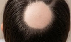 Alopecia Areataa Umut Veren Gelişmeler