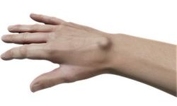 Kistler Neden Ortaya Çıkar, Ne Zaman Müdahale Gerekir?