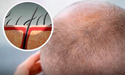 Kellik Tarih mi Oluyor? Şeker İçerikli Jel Saç Büyümesini Tetikledi