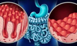 Çölyak Nedir? Bir Dilim Ekmekle Başlayan Tehlike