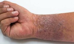 Egzama Belirtileri ve En Etkili Tedavi Yolları