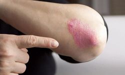 Sedef Hastalığı Tedavisi Var mı? Uzmanlar Açıkladı