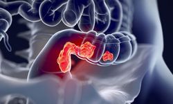 Rektal Kanser Artıyor: Genç Yetişkinlerde Hastalık Yükü Büyüyor