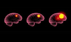 Glioblastoma nedir? Belirtileri ve en güncel tedavi yöntemleri
