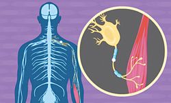Fark Edilmeyen Hastalık ALS: Vücut Önceden Sinyal Veriyor