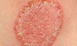 Sıcak Hava ve Terleme Fungal Enfeksiyonları Artırıyor: Uzmanlardan Uyarı