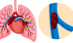 Pulmoner Emboli Nedir, Nasıl Anlaşılır? Belirti, Tanı ve Tedavide Yeni Dönem