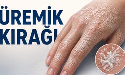 Üremik Kırağı (Uremic Frost) Nedir? Ciltte Görülen Bu Beyaz Tabaka Ne Anlama Gelir?