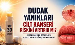 Dudak Yanığı Basit Bir Yaz Sorunu Değil: Uzmanlardan SPF Uyarısı