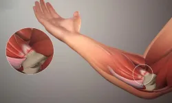 Tenisçi dirseği nedir ? Belirtileri, nedenleri ve güncel tedavi yöntemleri