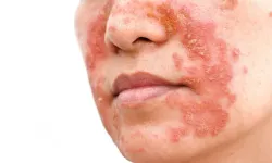 Seboreik Dermatit: Belirtileri, Nedenleri ve Güncel Tedavi Seçenekleri