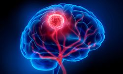 Glioblastoma: En Agresif Beyin Kanseri İçin Yeni Tedaviler Neden Hâlâ Zor?