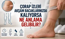 Çorap İzleri Akşam Bacaklarınızda Kalıyorsa Ne Anlama Gelebilir?