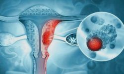 Endometriozis Sadece “Ağrılı Adet” Değil: Vücudun Verdiği İşaretler Neler?