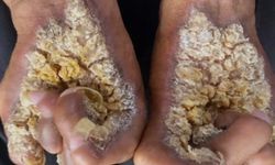 Siğil Sanılabiliyor: Epidermodysplasia Verruciformis Nedir?