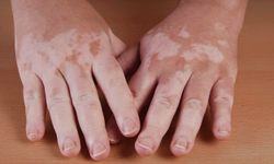 Vitiligo Sadece Cildi Etkilemiyor: Tanıdan Tedaviye Bilinmesi Gerekenler