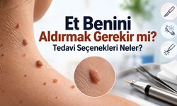 Et Beni Nedir, Neden Çıkar? Et Benleri Hakkında Bilmeniz Gerekenler