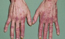 Lupus yalnızca eklemleri etkilemiyor: Böbrek tutulumu nasıl fark edilir?