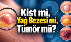 Çoğu Kist Zararsız Ama Her Şişlik Kist Değil: Ne Zaman Kontrol Gerekir?